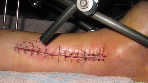 First Surgery Incision