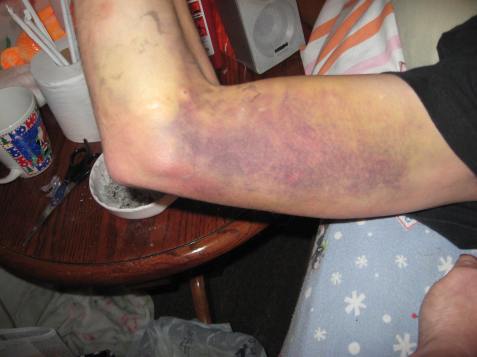 Right Arm Bruise